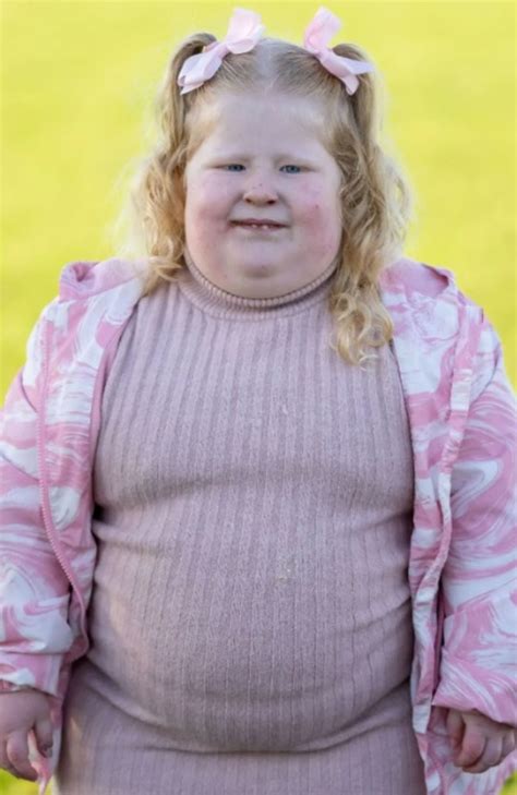 prader willi syndrome pictures